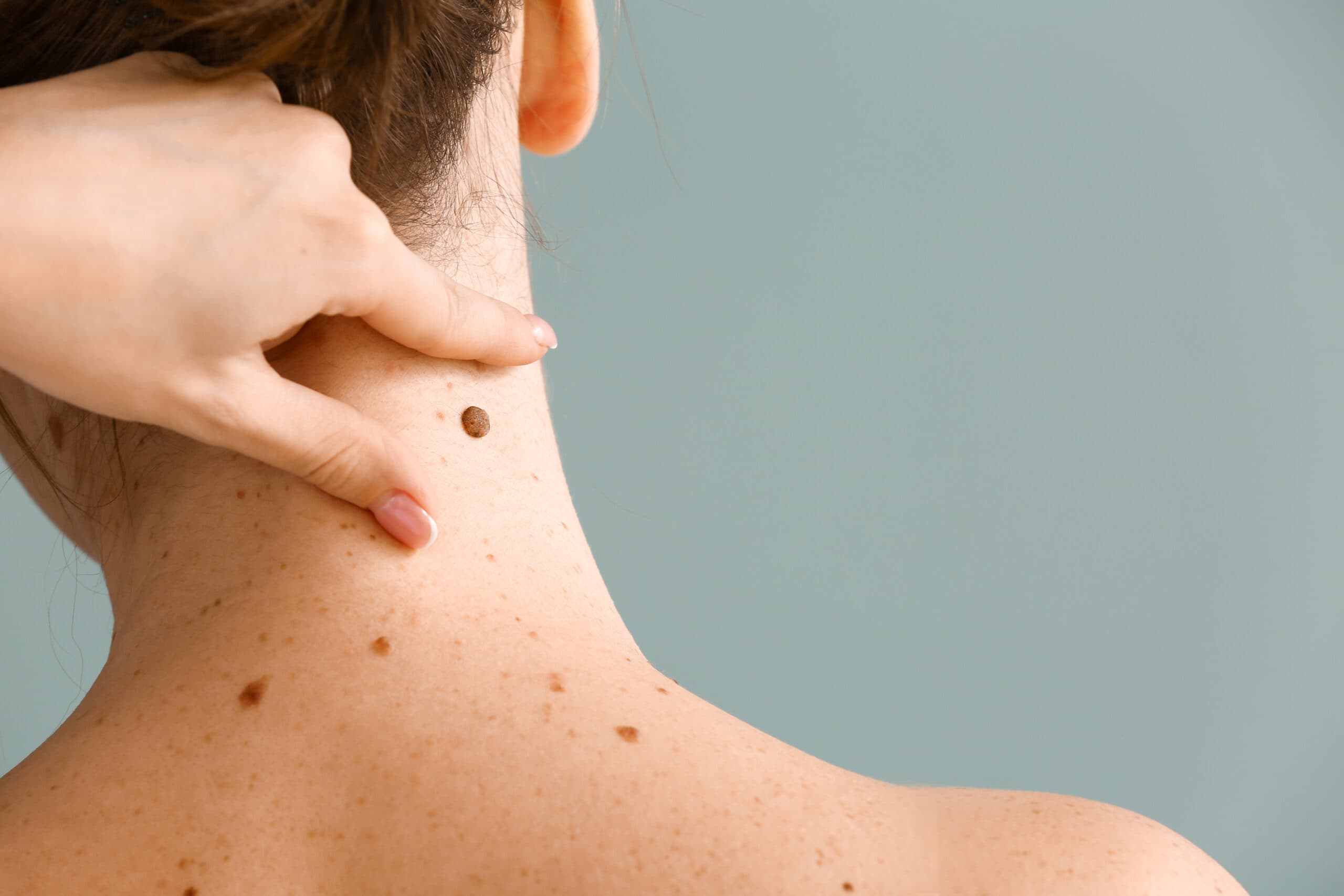 Mole Removal Recovery