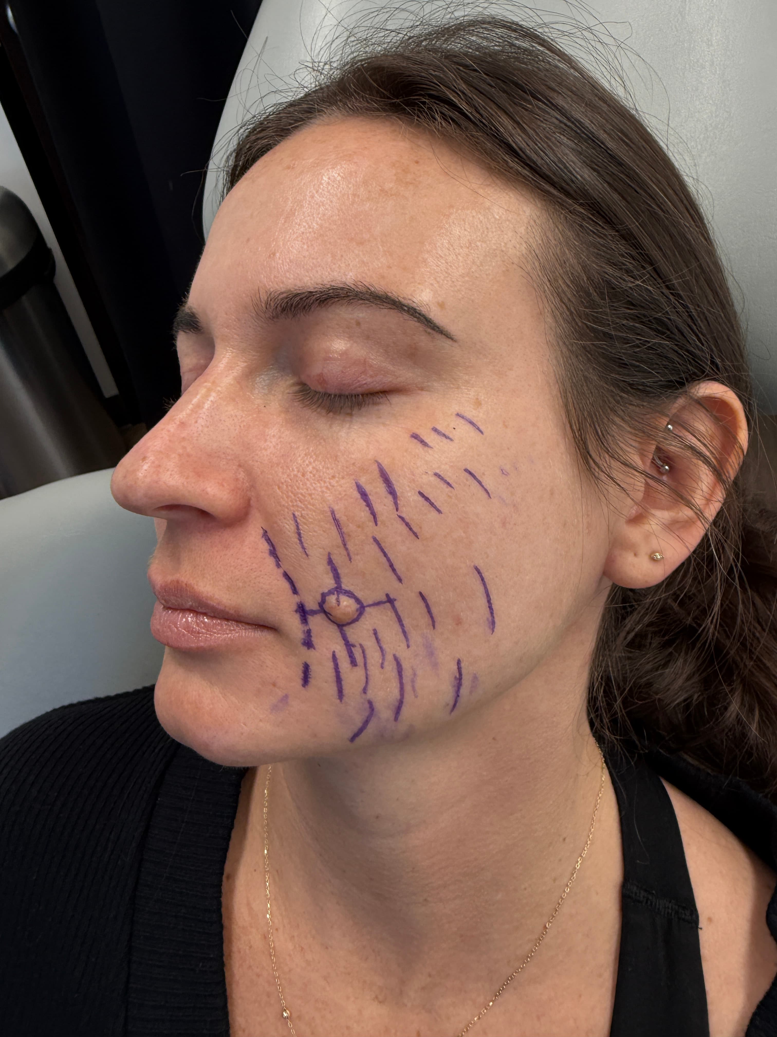 Pre-treatment assessment of cheek movement near the mouth