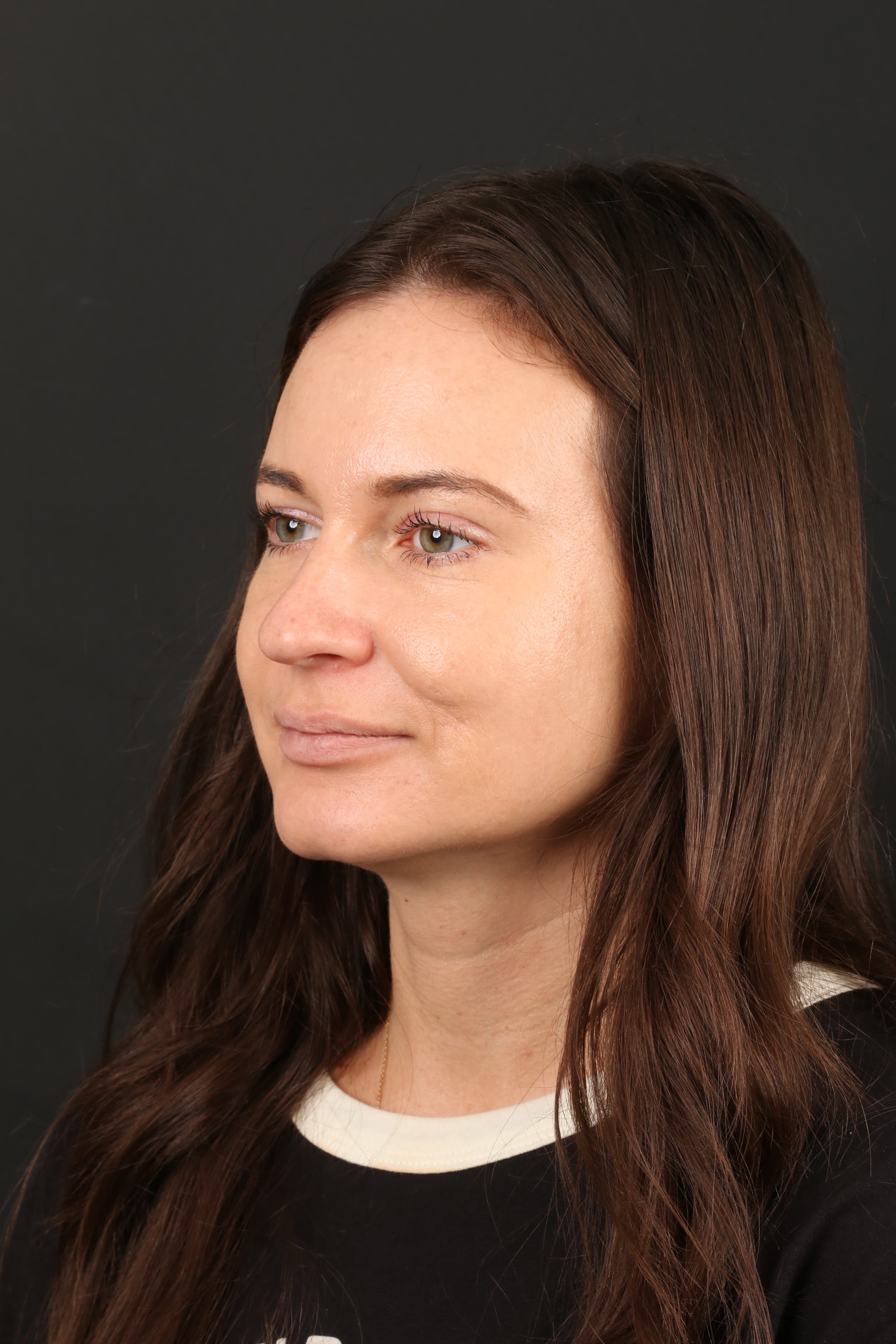 Four-month cheek contour after Molectomy