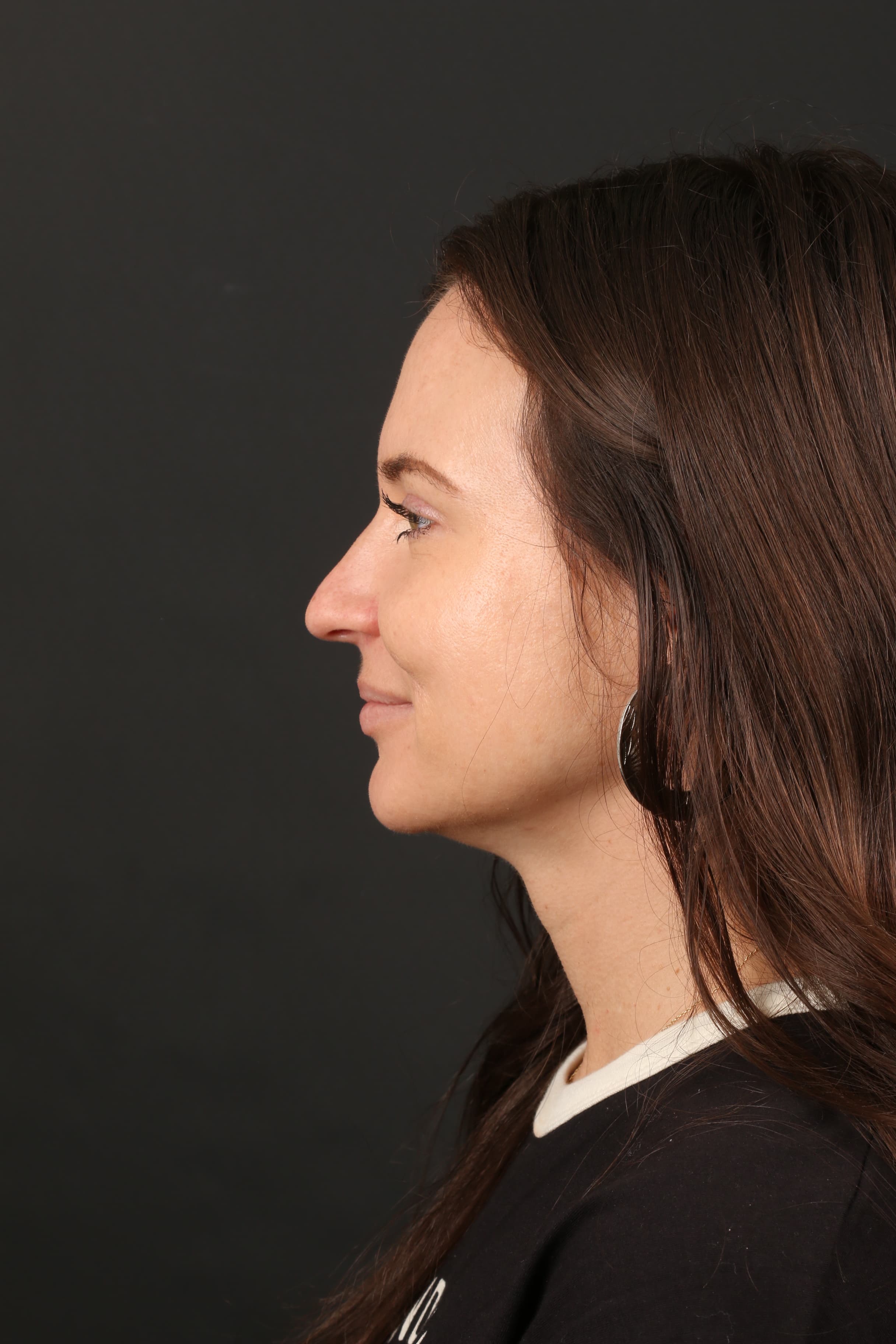 Four-month follow-up showing the healed cheek treatment area