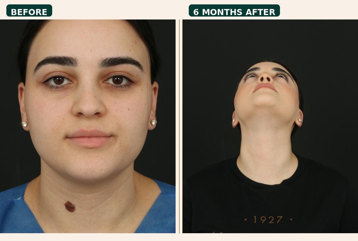 Before and six-month follow-up photographs from a neck mole removal case study