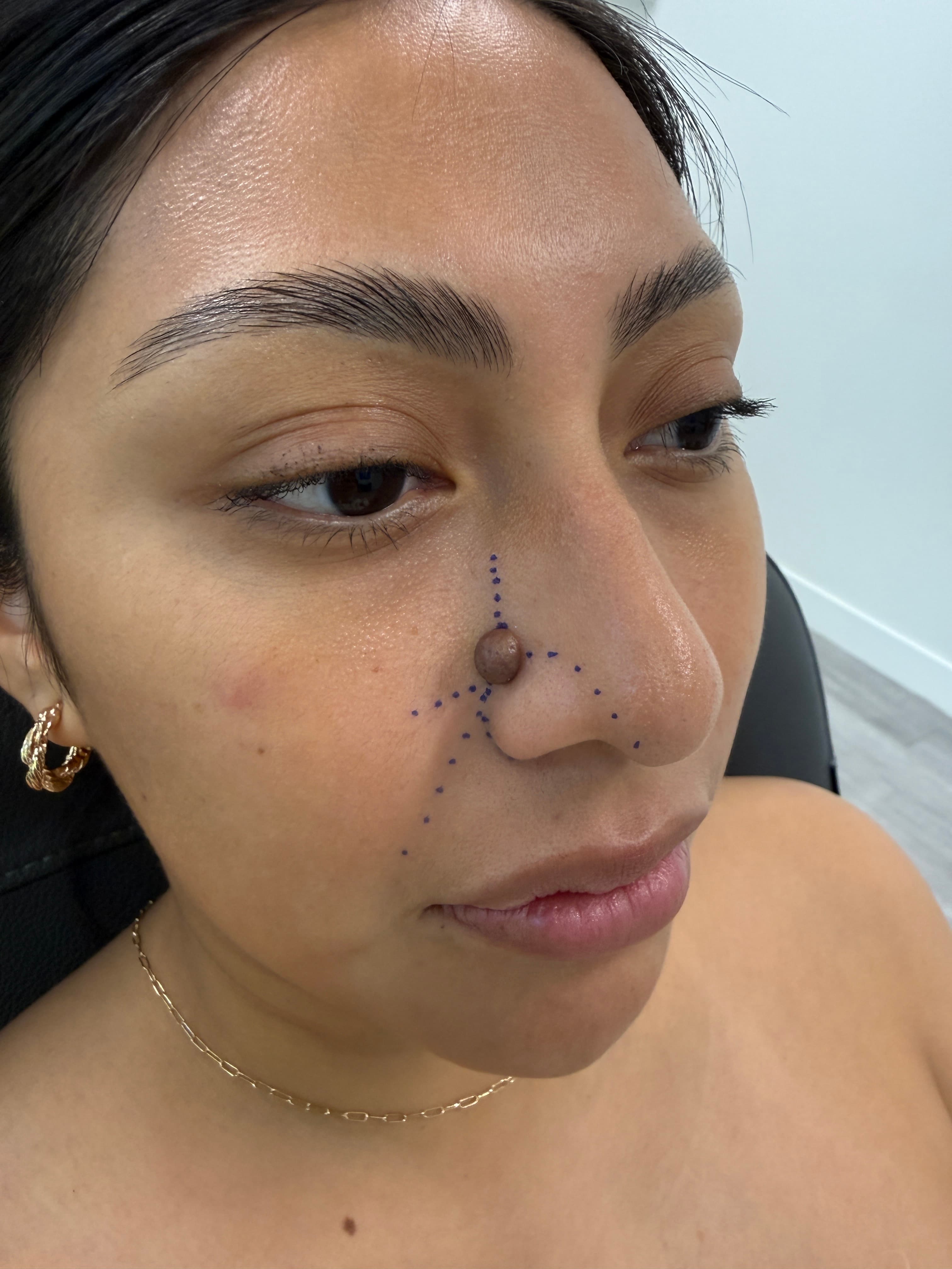 Pre-operative nasal subunit markings used to plan nose mole excision and closure
