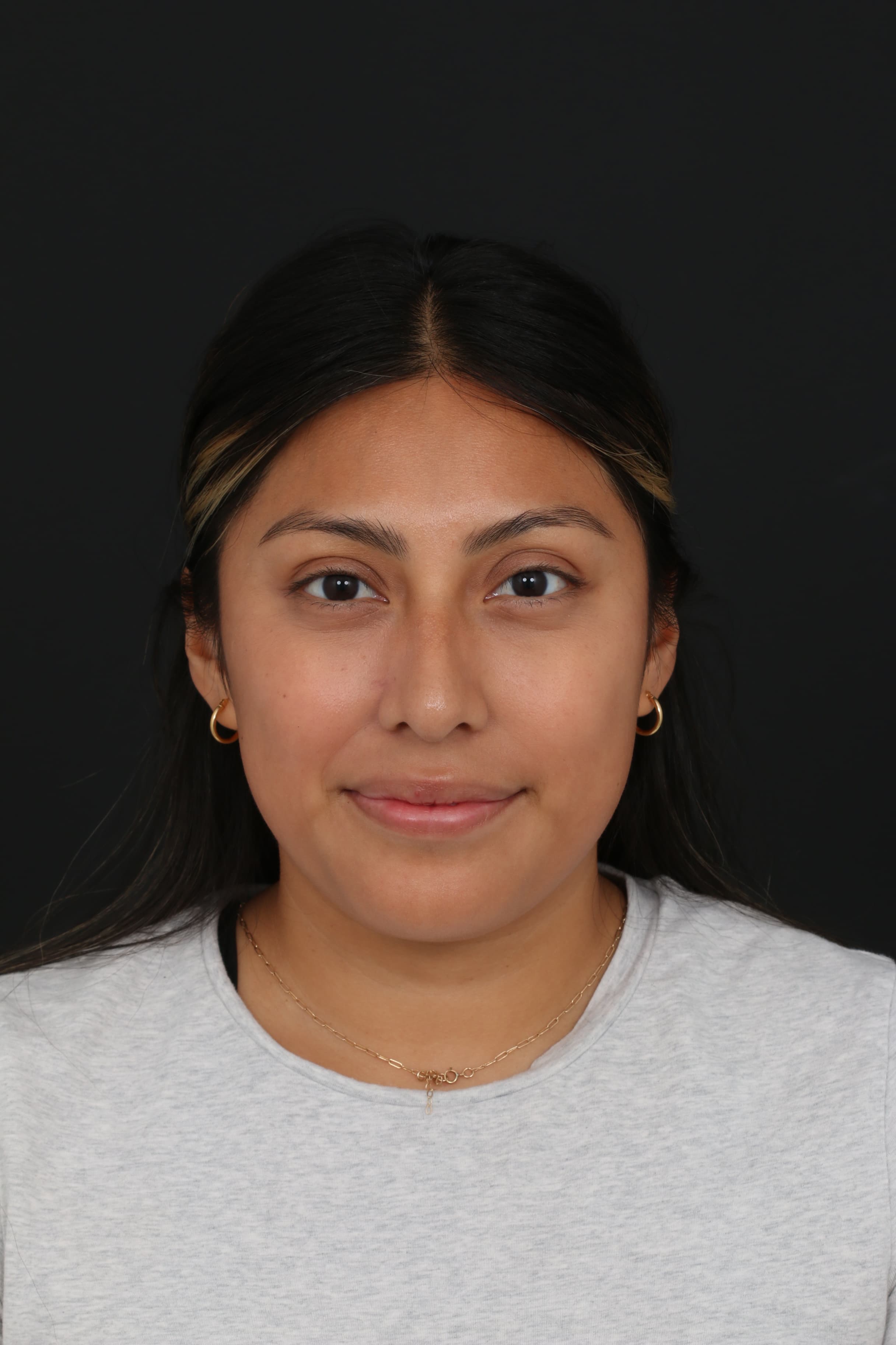 Frontal six-month result after nose mole removal with Molectomy