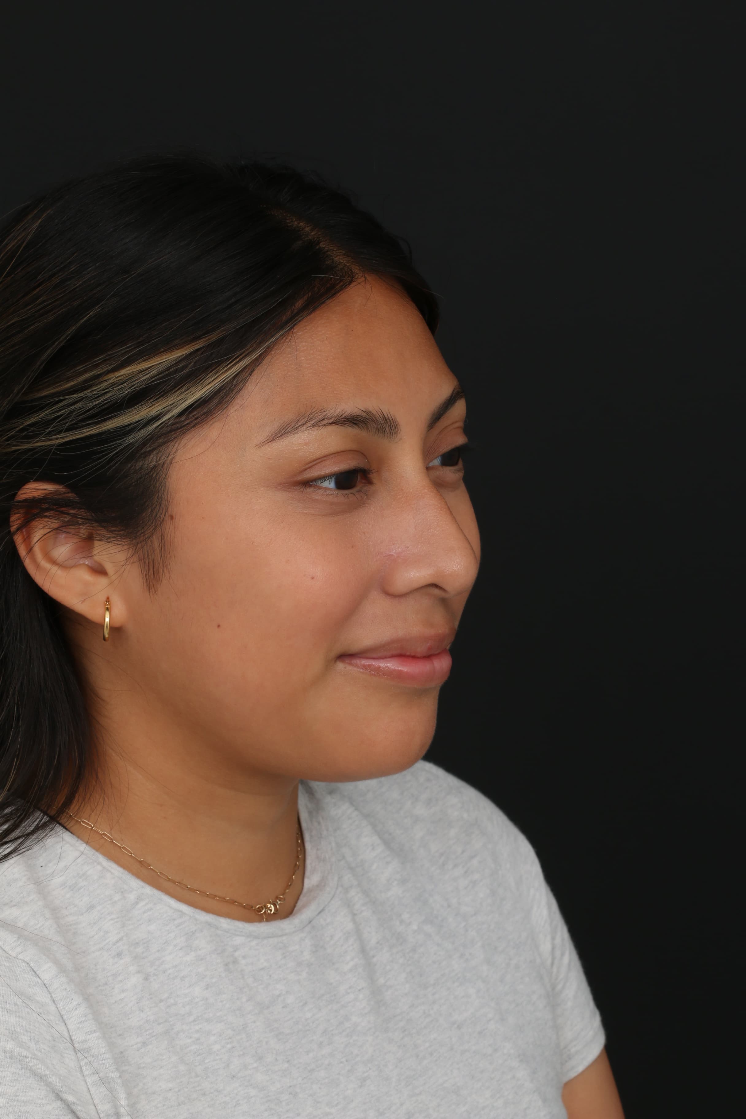 Six-month three-quarter view after nose mole removal