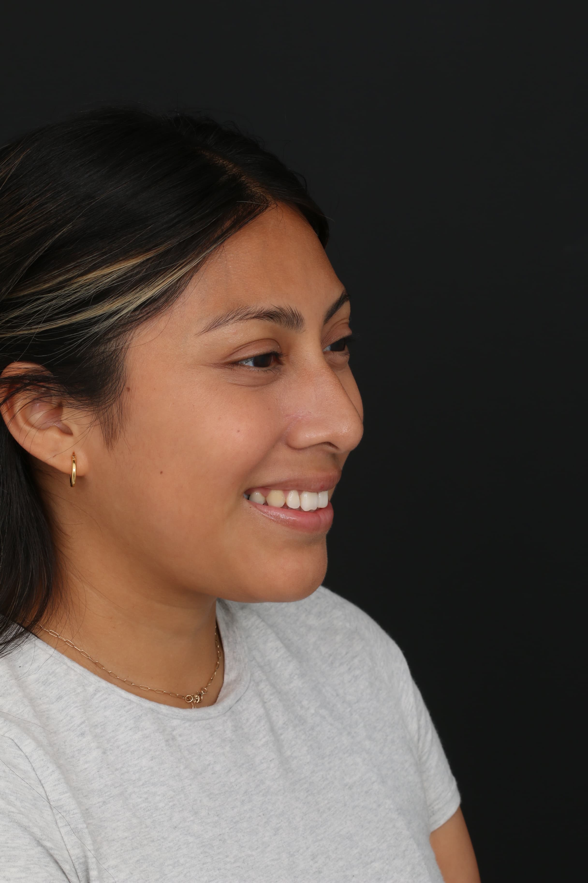 Six-month smiling view showing the healed result during facial expression
