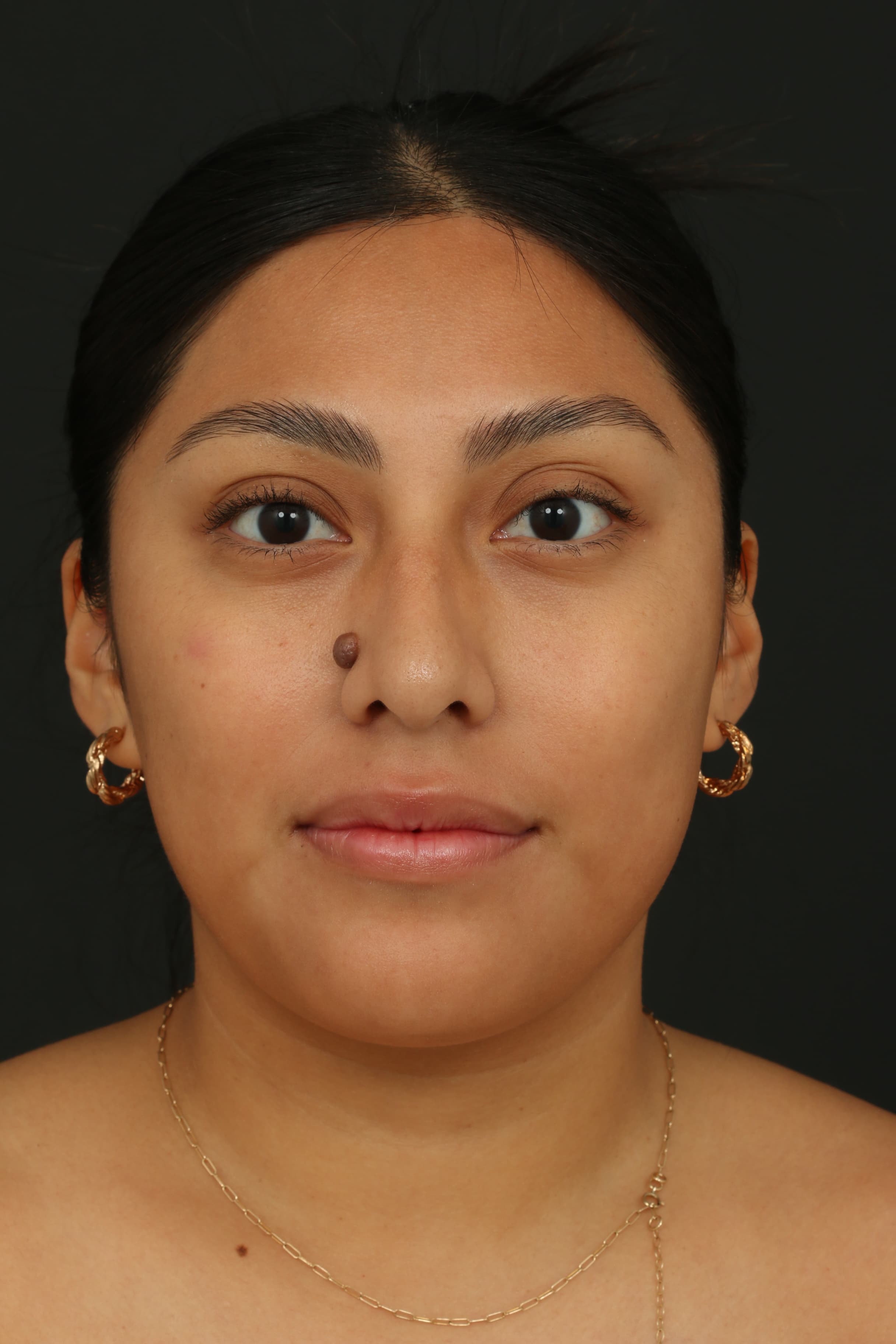 Frontal pre-treatment view showing a raised pigmented mole on the nose