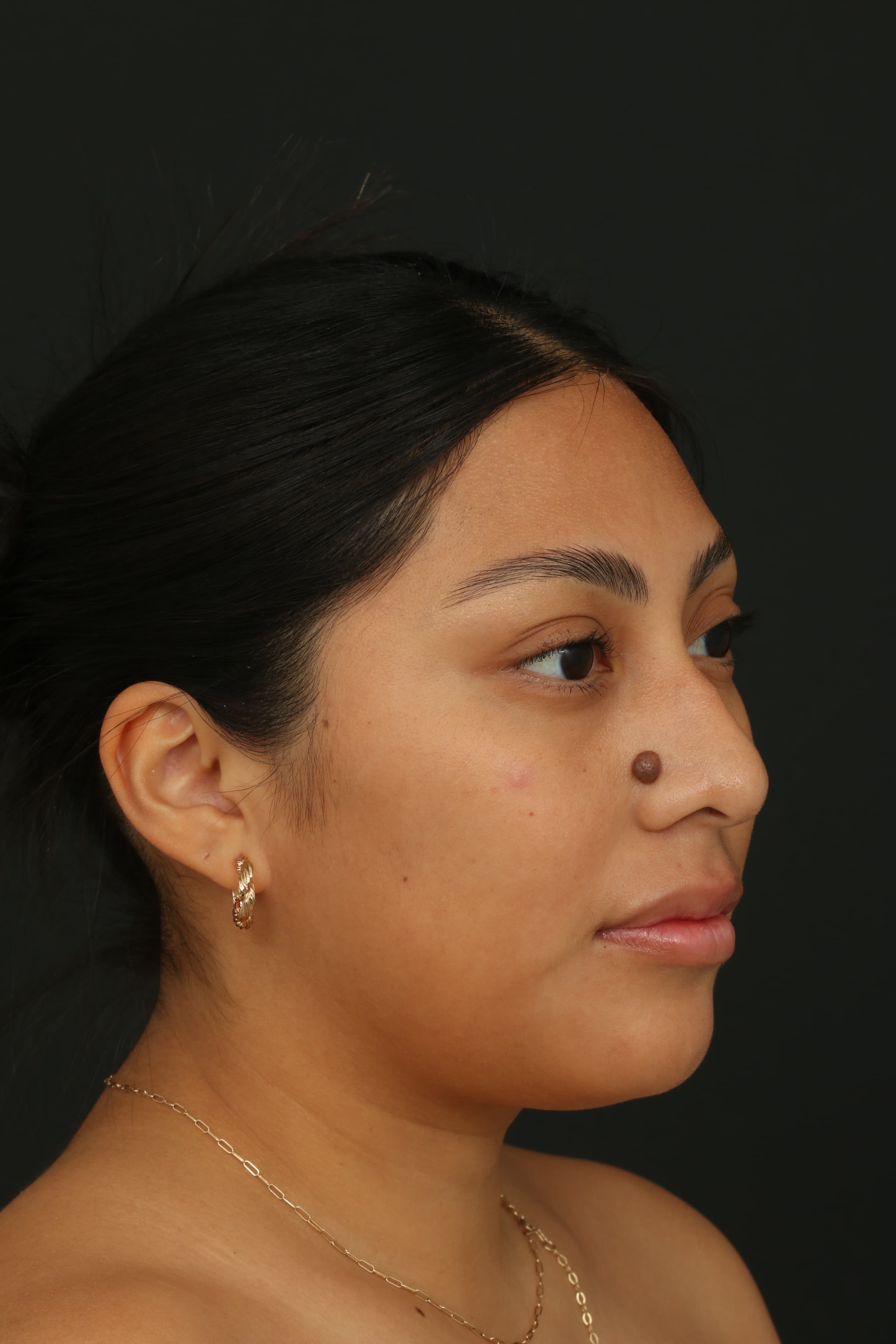 Three-quarter pre-treatment view showing the size and projection of the nose mole
