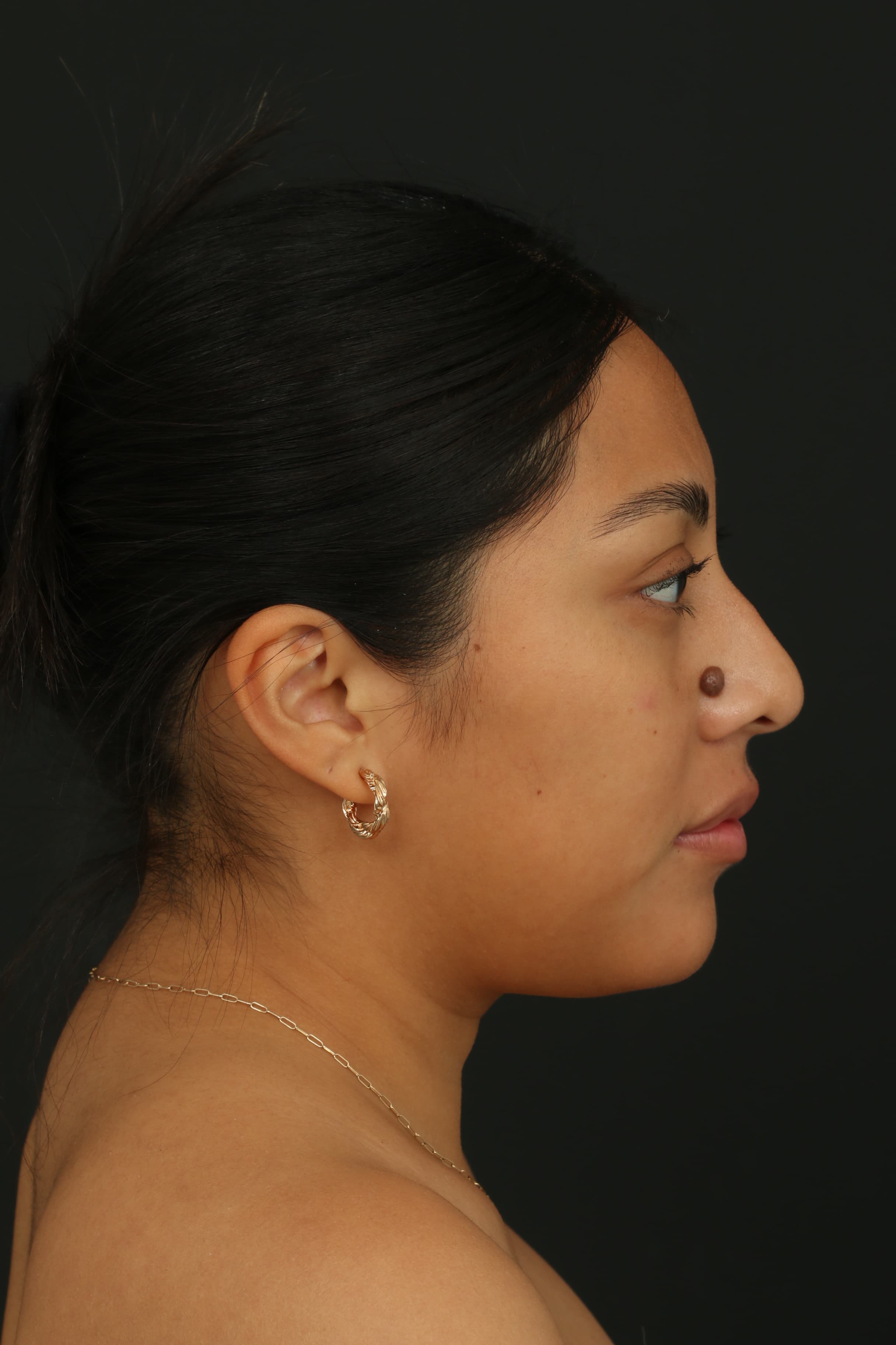 Pre-treatment profile view of the nose mole
