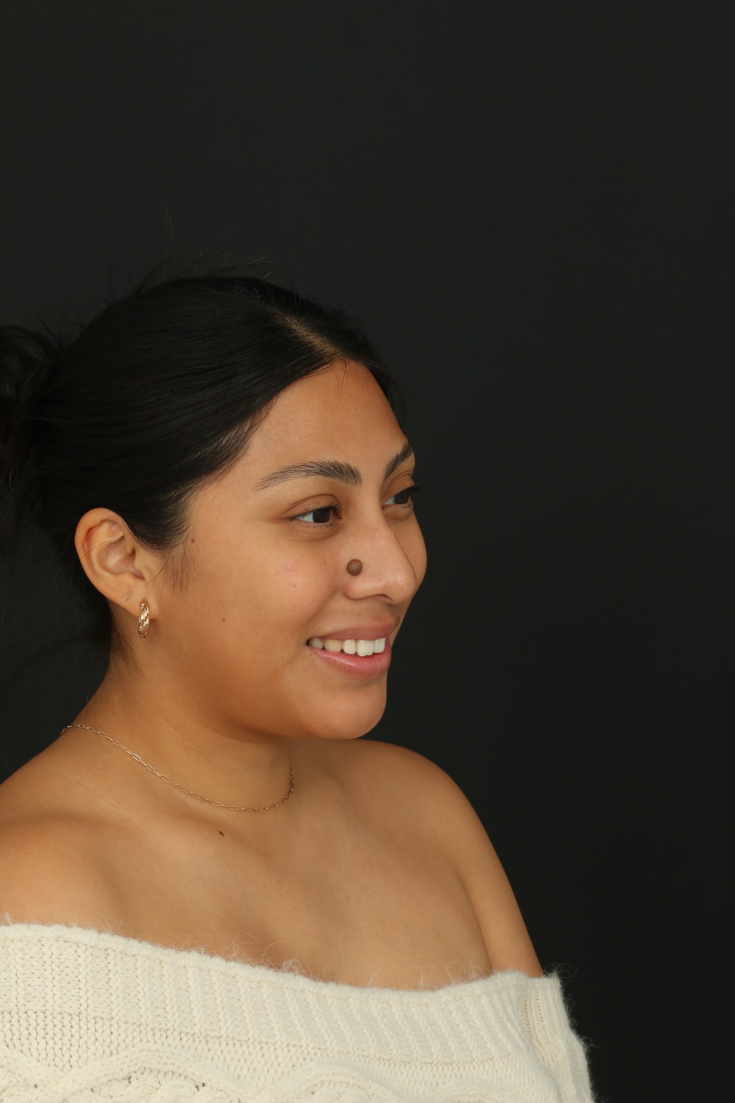 Pre-treatment smiling view showing the nose mole during facial expression