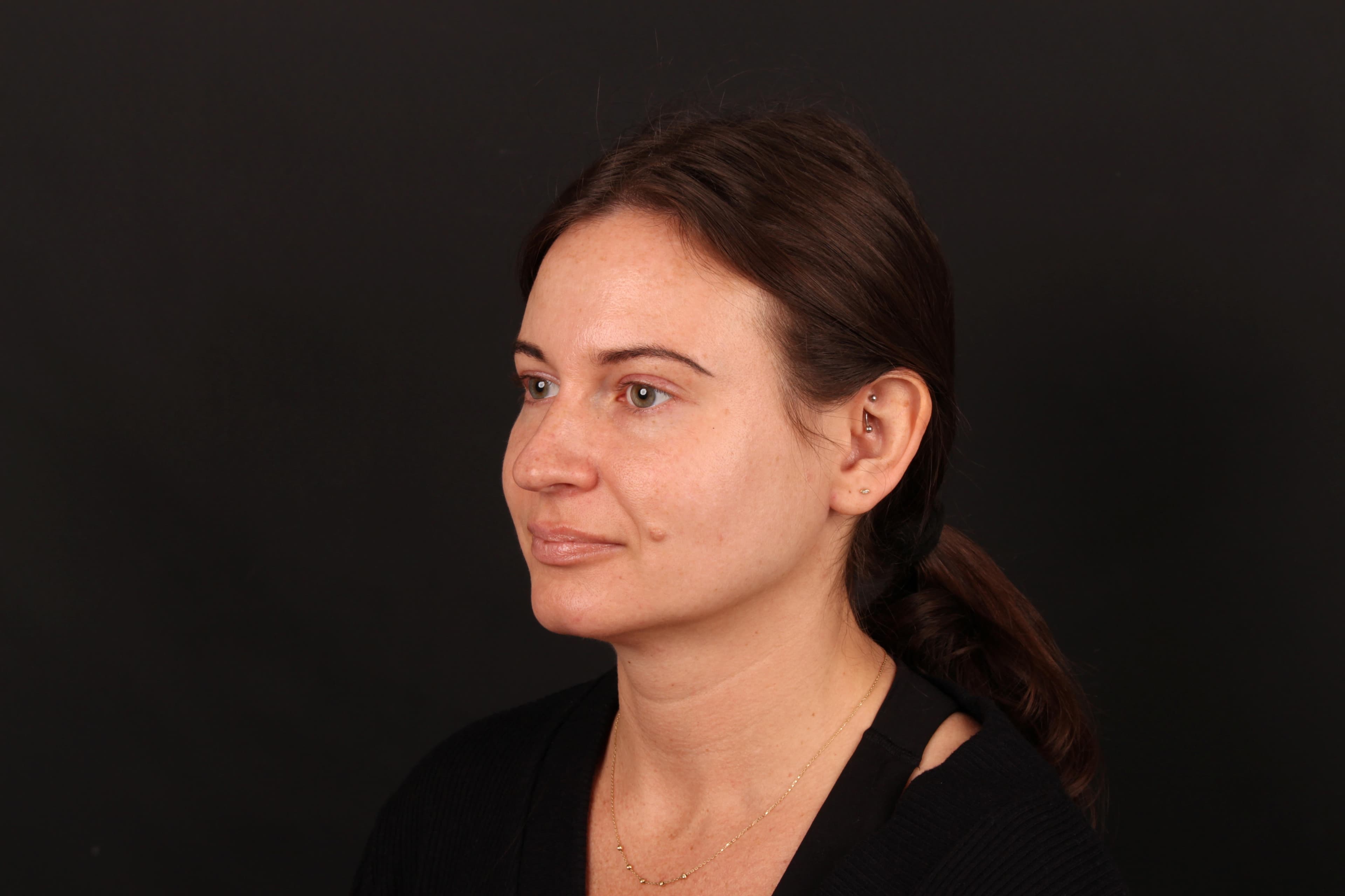 Dynamic pre-treatment view used for cheek movement assessment