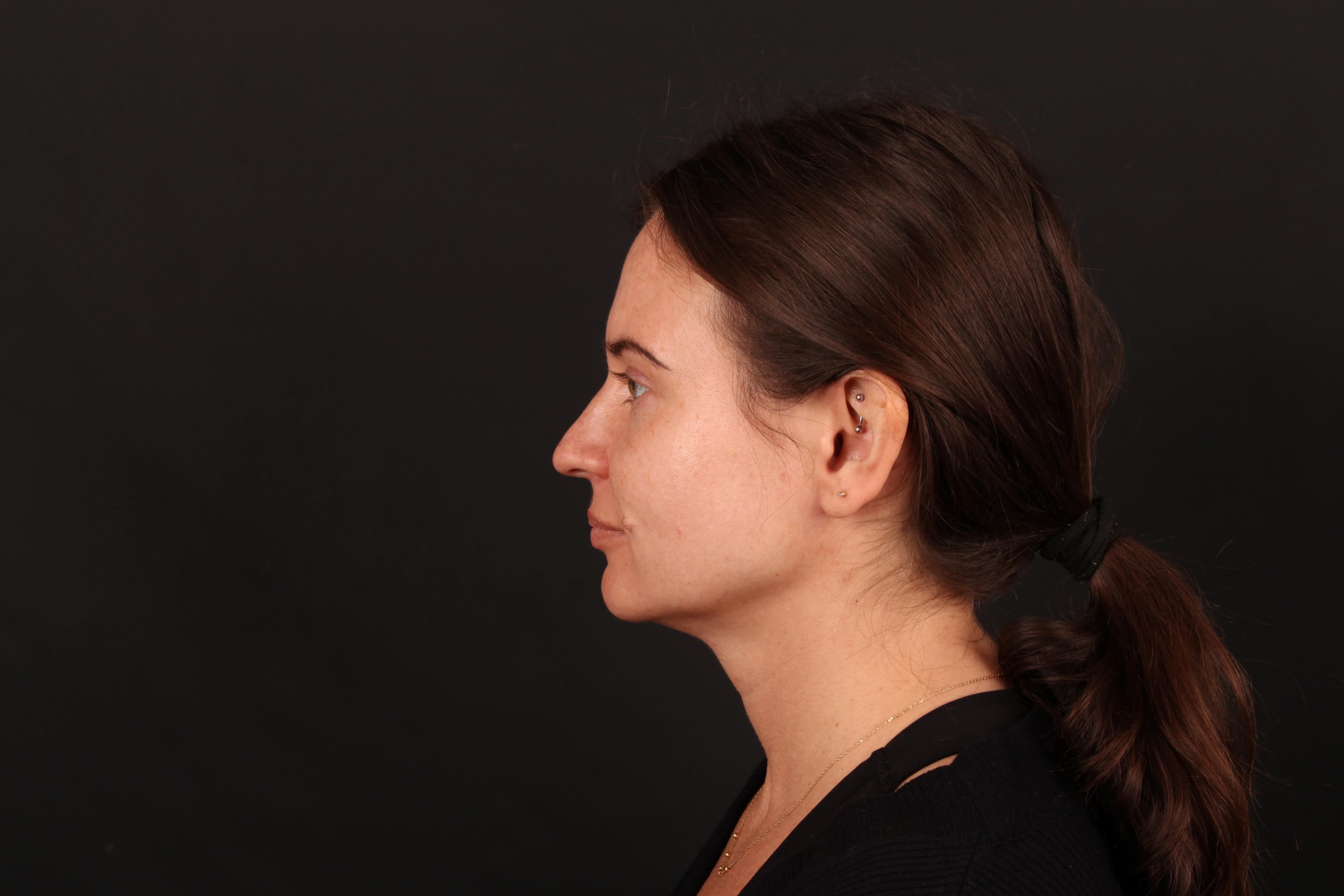 Pre-treatment view showing the cheek mole in relation to the nearby corner of the mouth