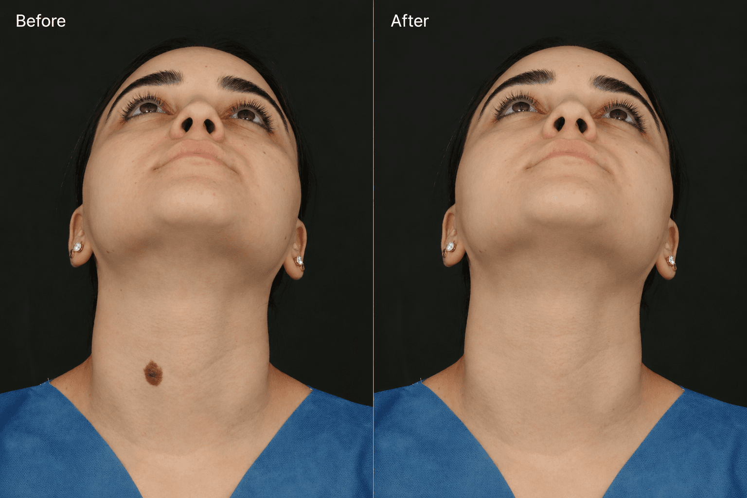Before and six-month after view of lower neck mole removal