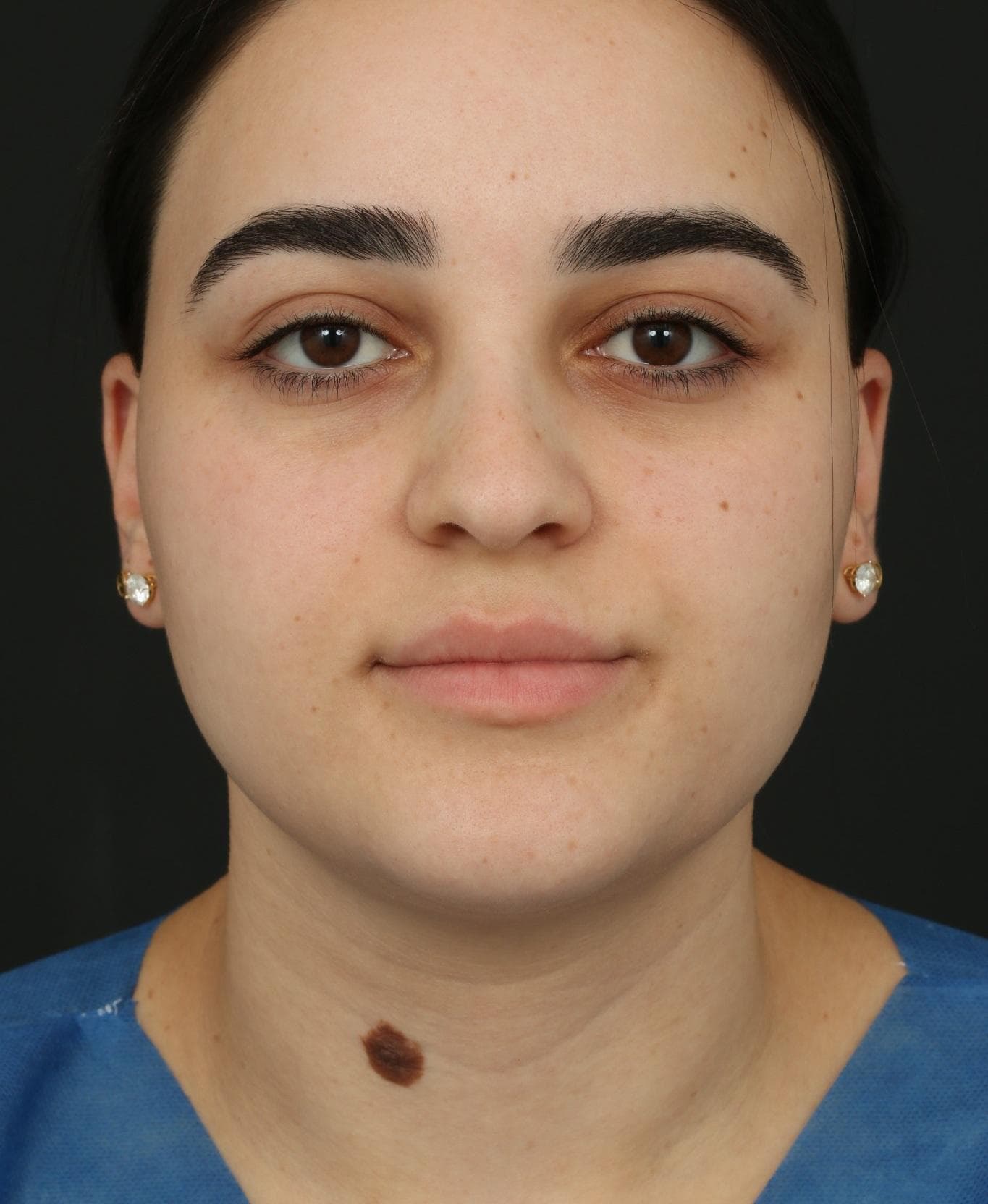 Pre-treatment frontal view of the lower neck mole