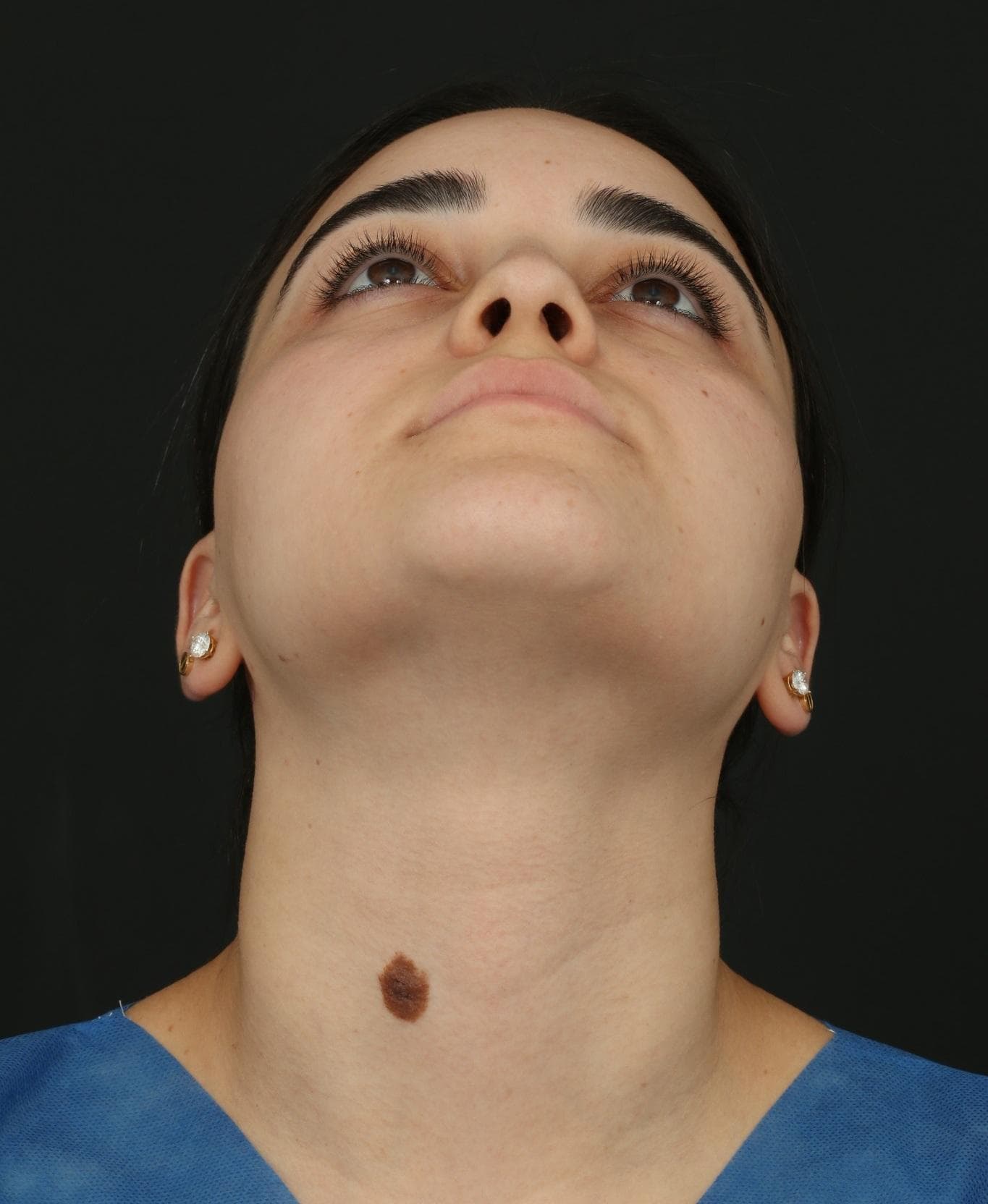 Upward-facing pre-treatment view showing the projection and location of the lower neck mole