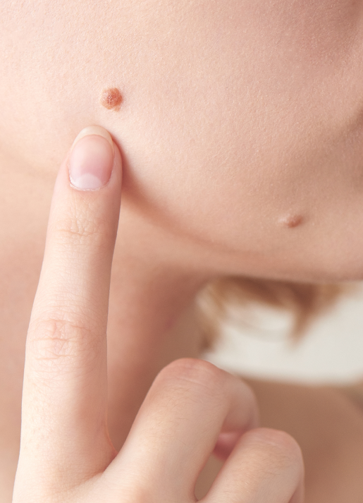 girl-points-large-moles-her-face-big-warts-close-up