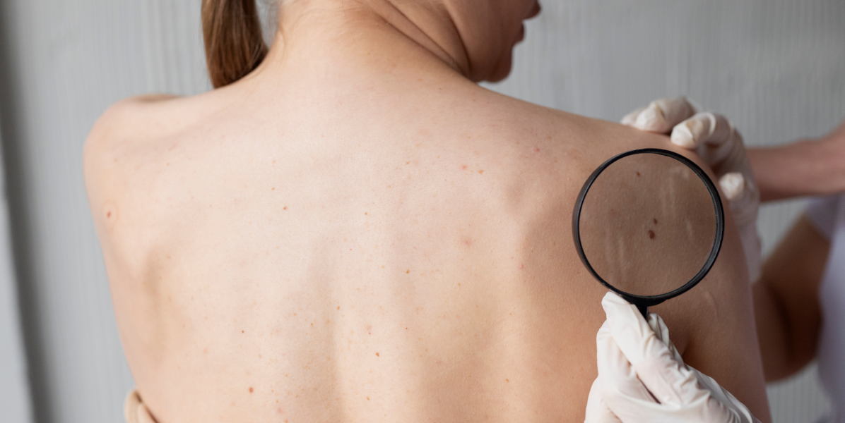 How to Care for Mole Removal