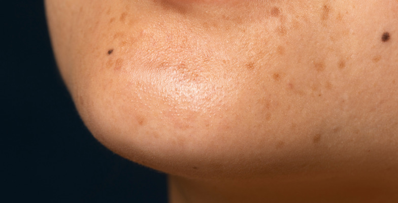 Considerations for Flat Mole