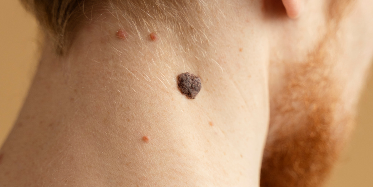 How to Remove a Flat Mole