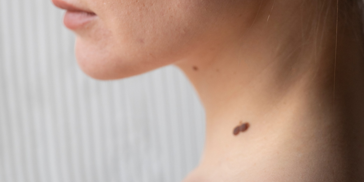 How Painful Is Mole Removal