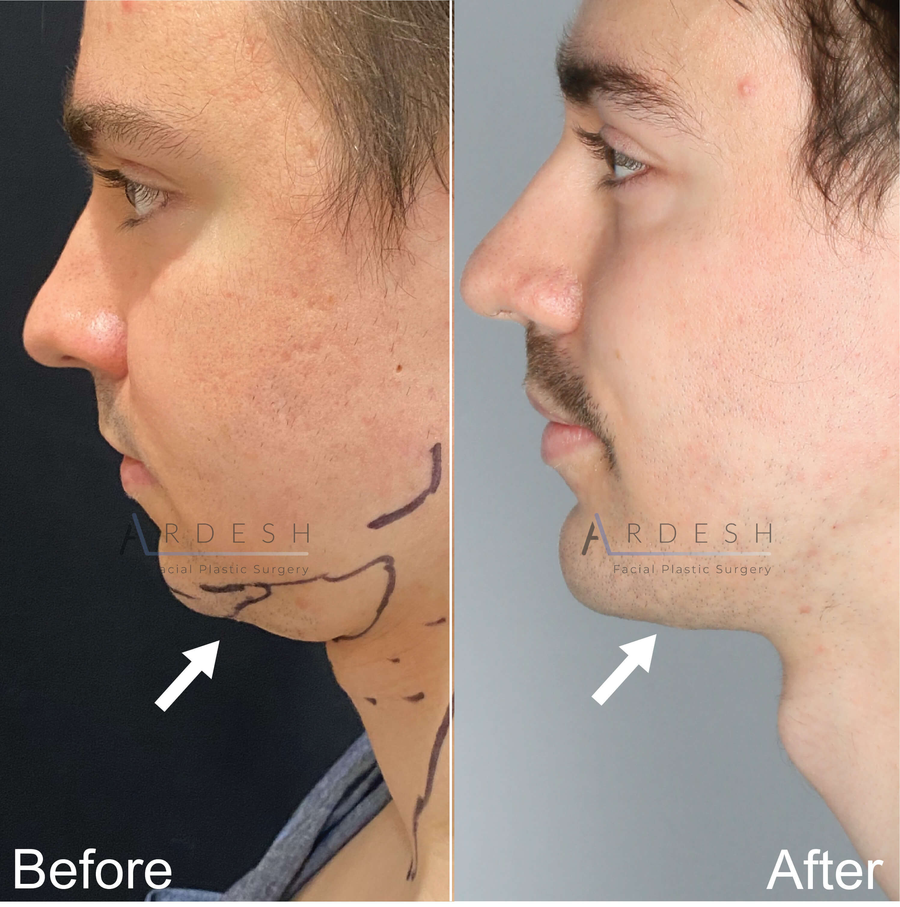 Chin Surgery Before and After | Ardesh Facial Plastic Surgery