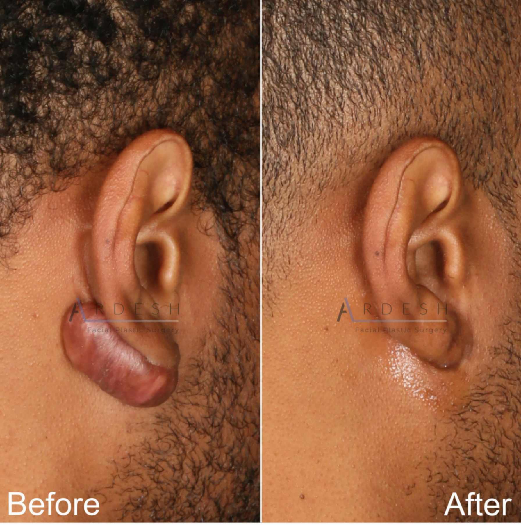 Ear Surgery Before and After | Ardesh Facial Plastic Surgery