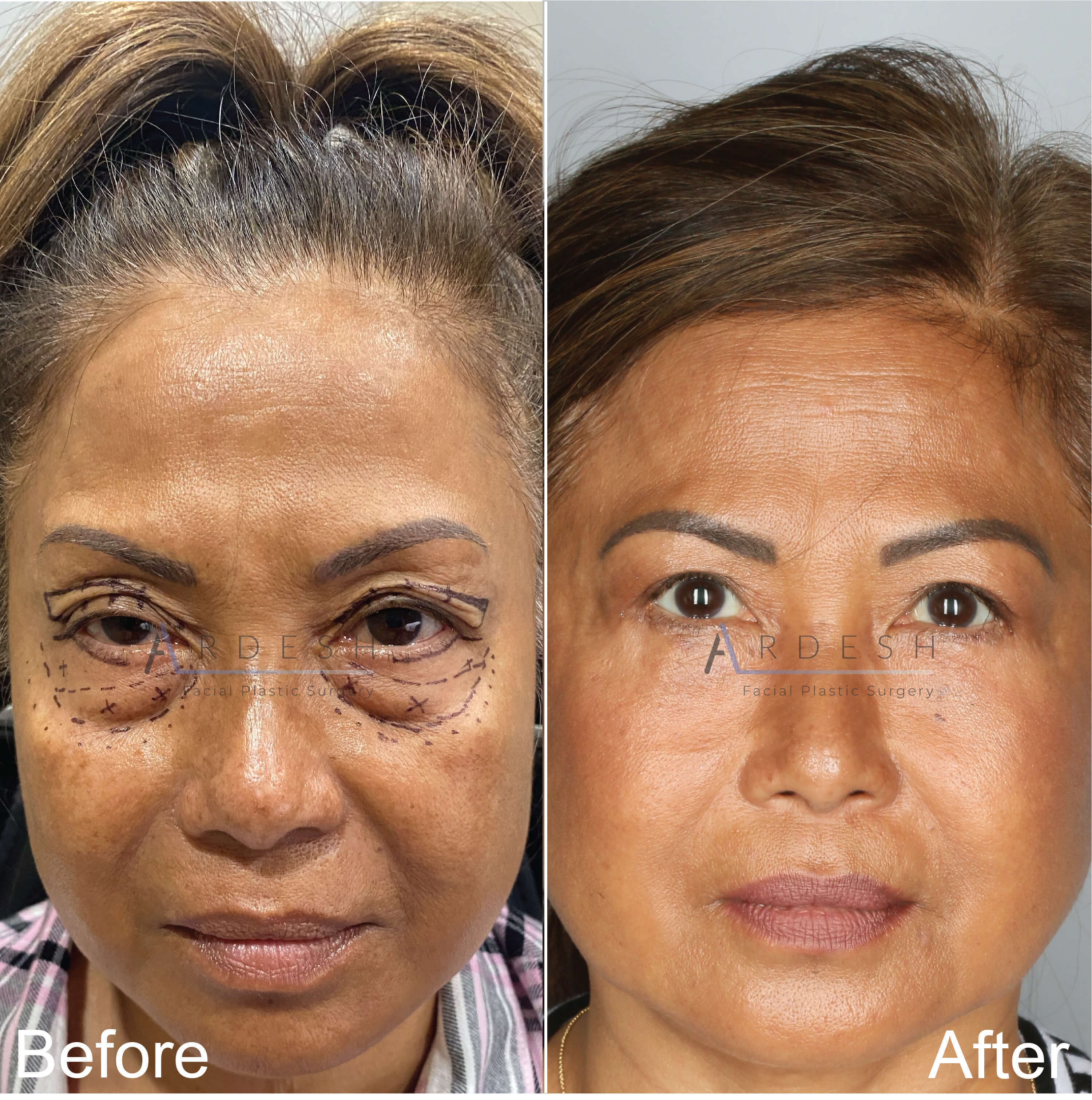Eyelid Surgery Before and After | Ardesh Facial Plastic Surgery