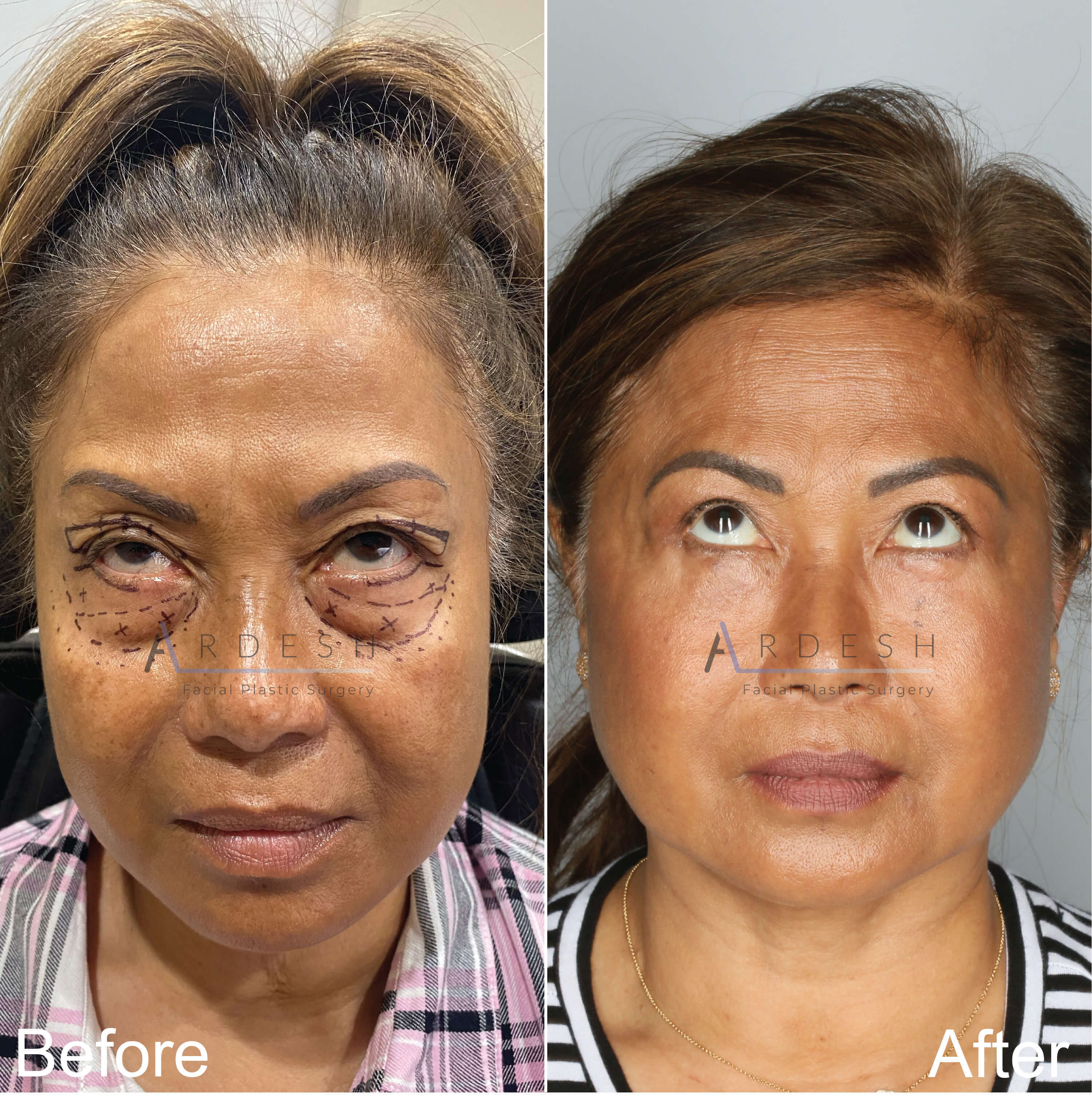 Eyelid Surgery Before and After | Ardesh Facial Plastic Surgery