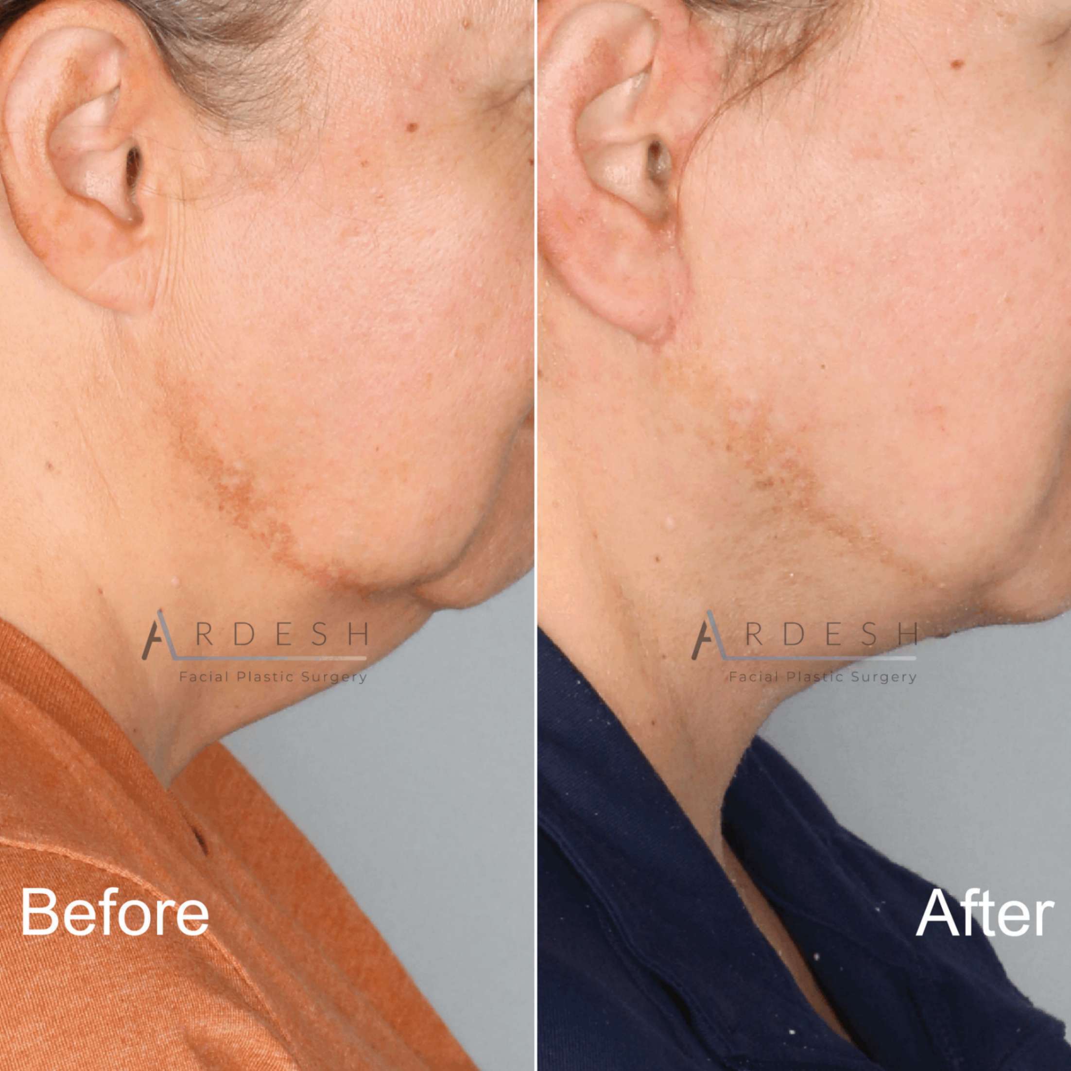 Facelift Before and After | Ardesh Facial Plastic Surgery