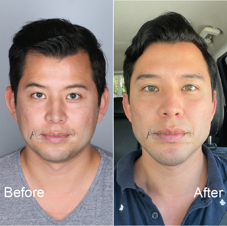 Facelift Before and After | Ardesh Facial Plastic Surgery