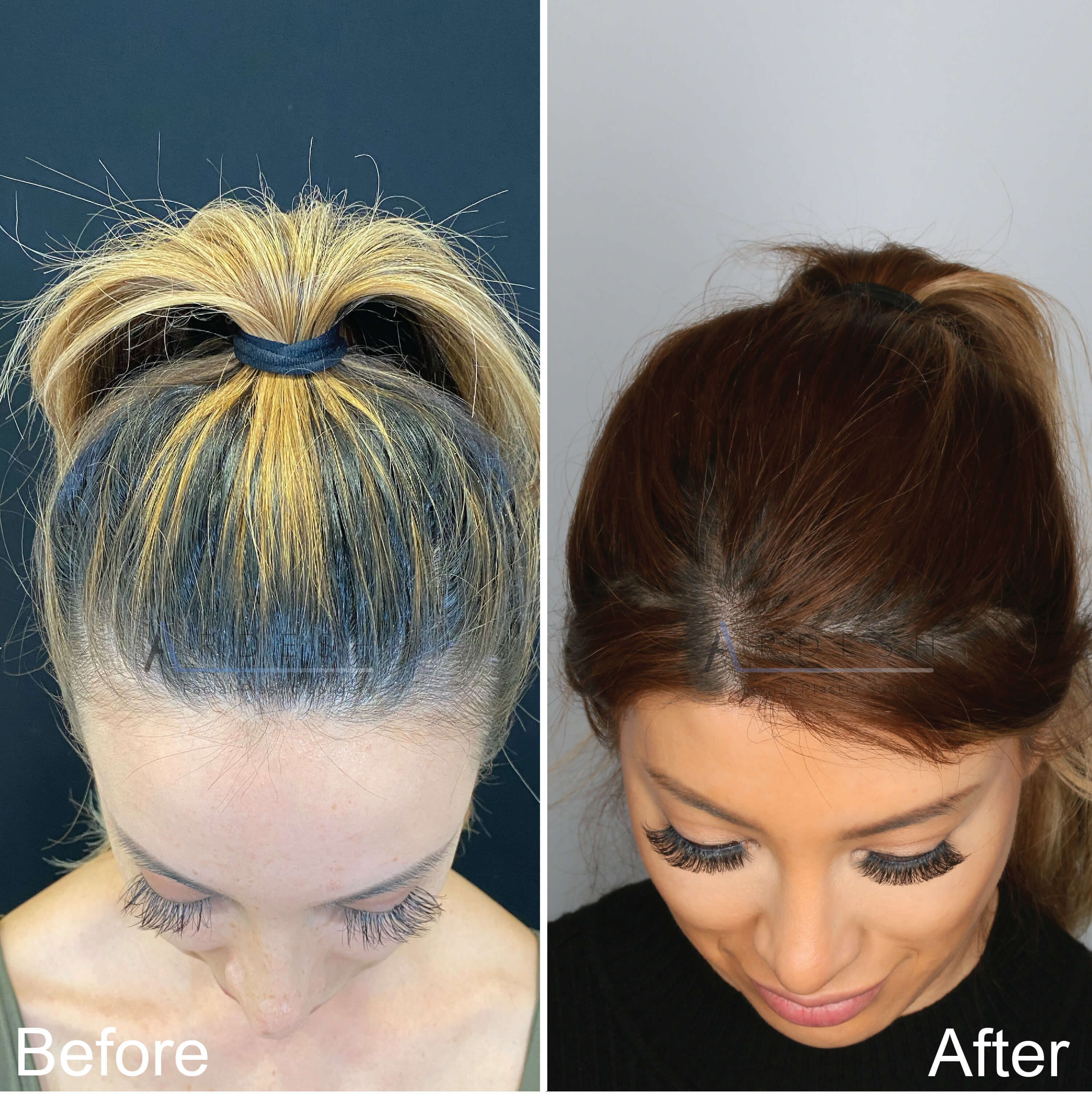 Hair Loss Treatment Before and After | Ardesh Facial Plastic Surgery