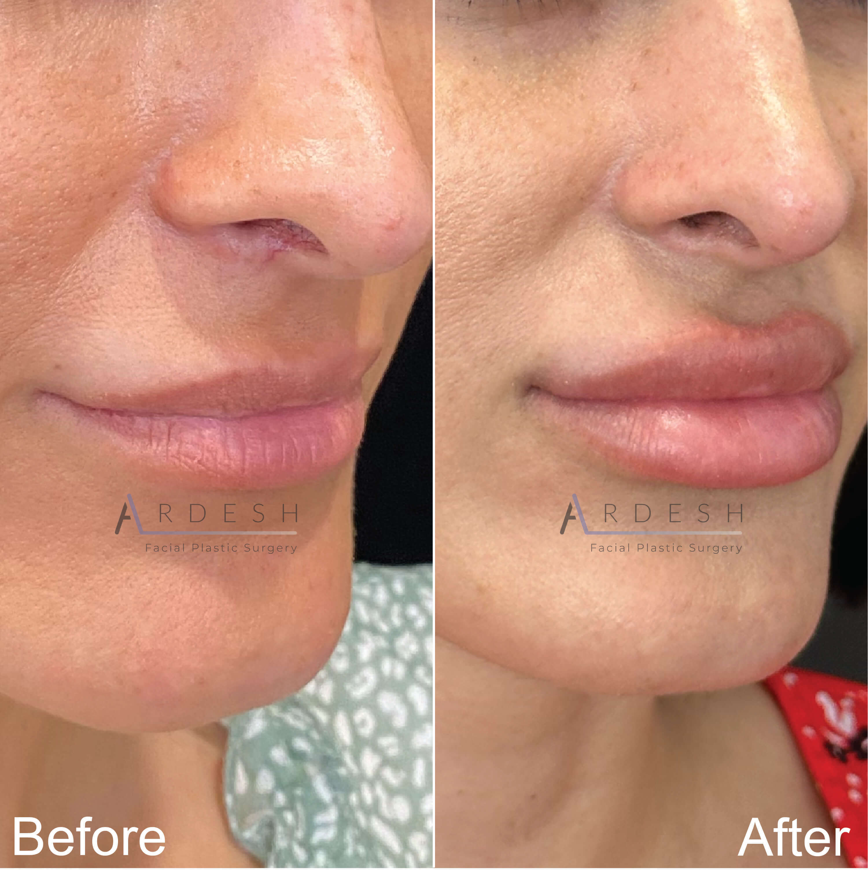 Lip Augmentation Before and After | Ardesh Facial Plastic Surgery