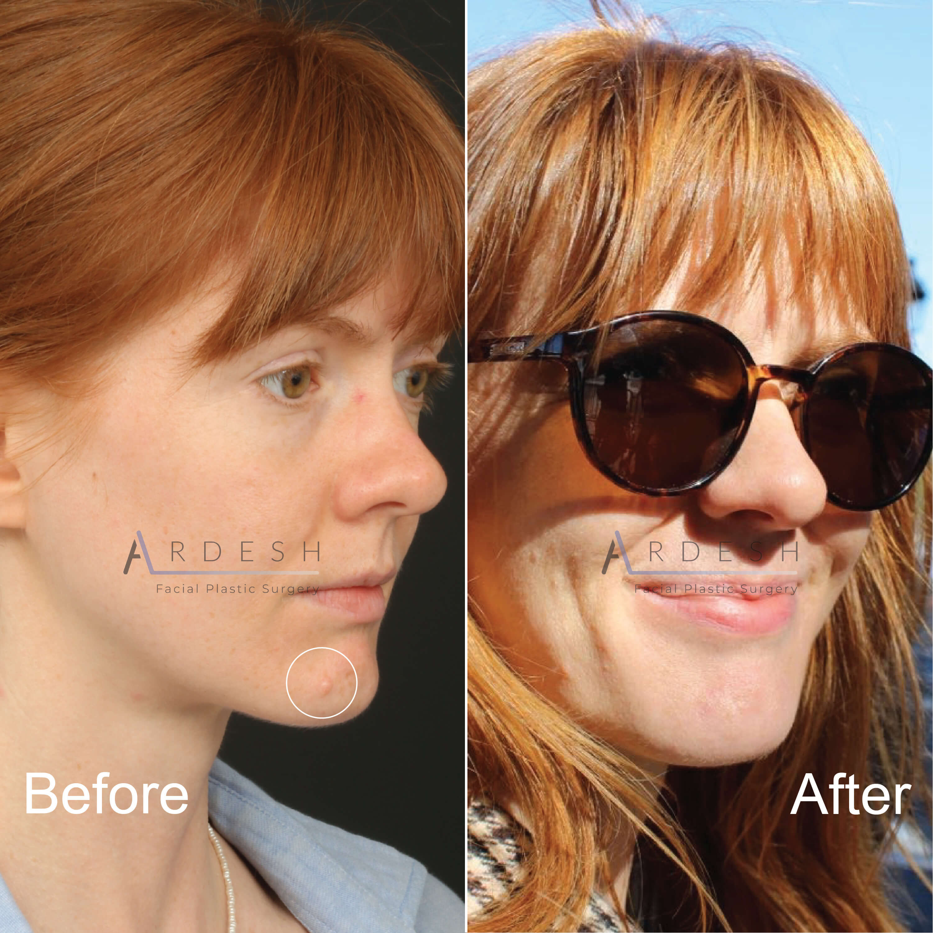 Mole Removal Before and After | Ardesh Facial Plastic Surgery