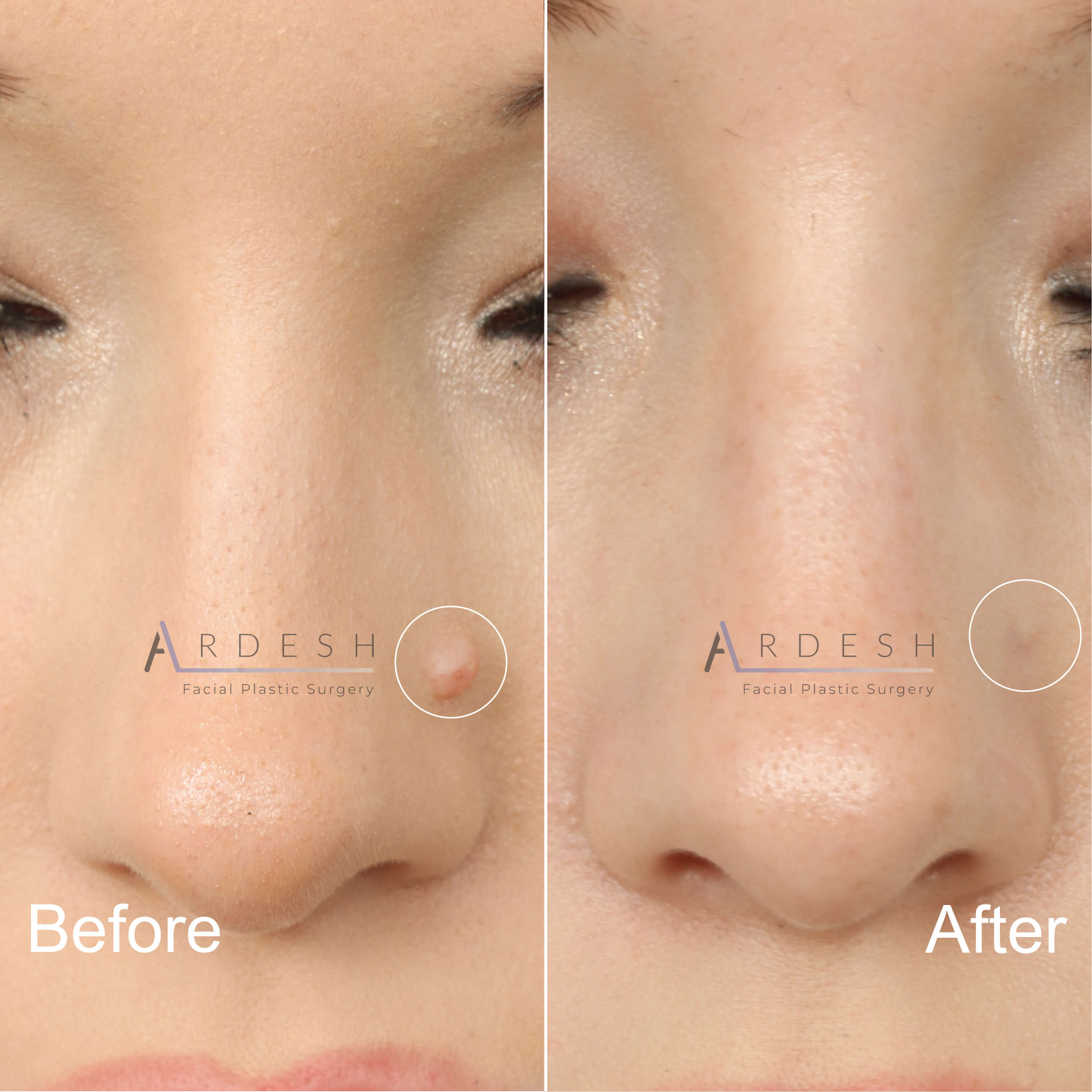Mole Removal Before and After | Ardesh Facial Plastic Surgery
