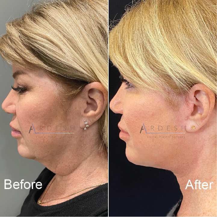 Neck Lift Before and After | Ardesh Facial Plastic Surgery