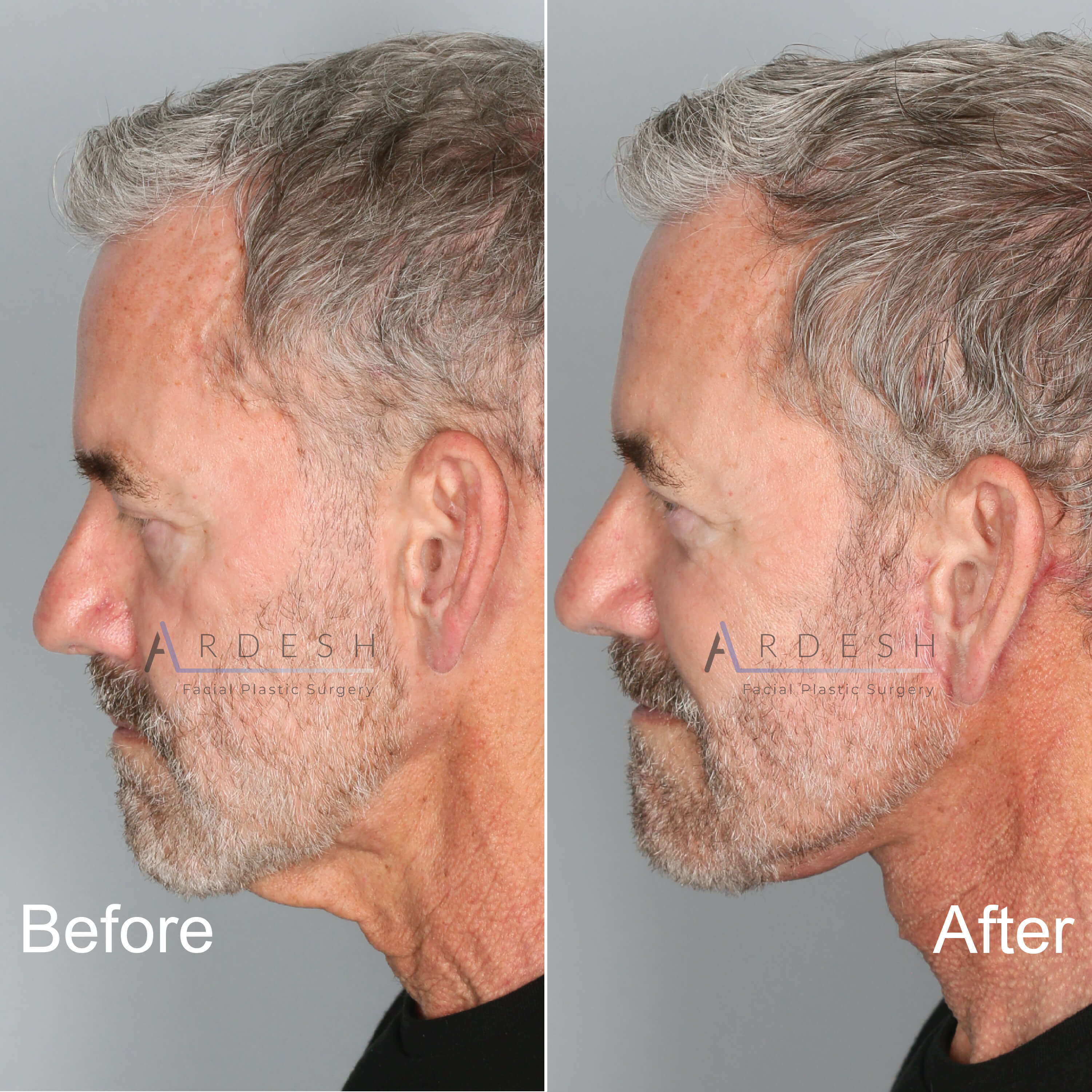 Neck Lift Before and After | Ardesh Facial Plastic Surgery