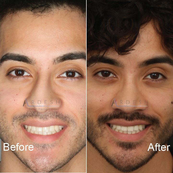 Rhinoplasty Before and After | Ardesh Facial Plastic Surgery