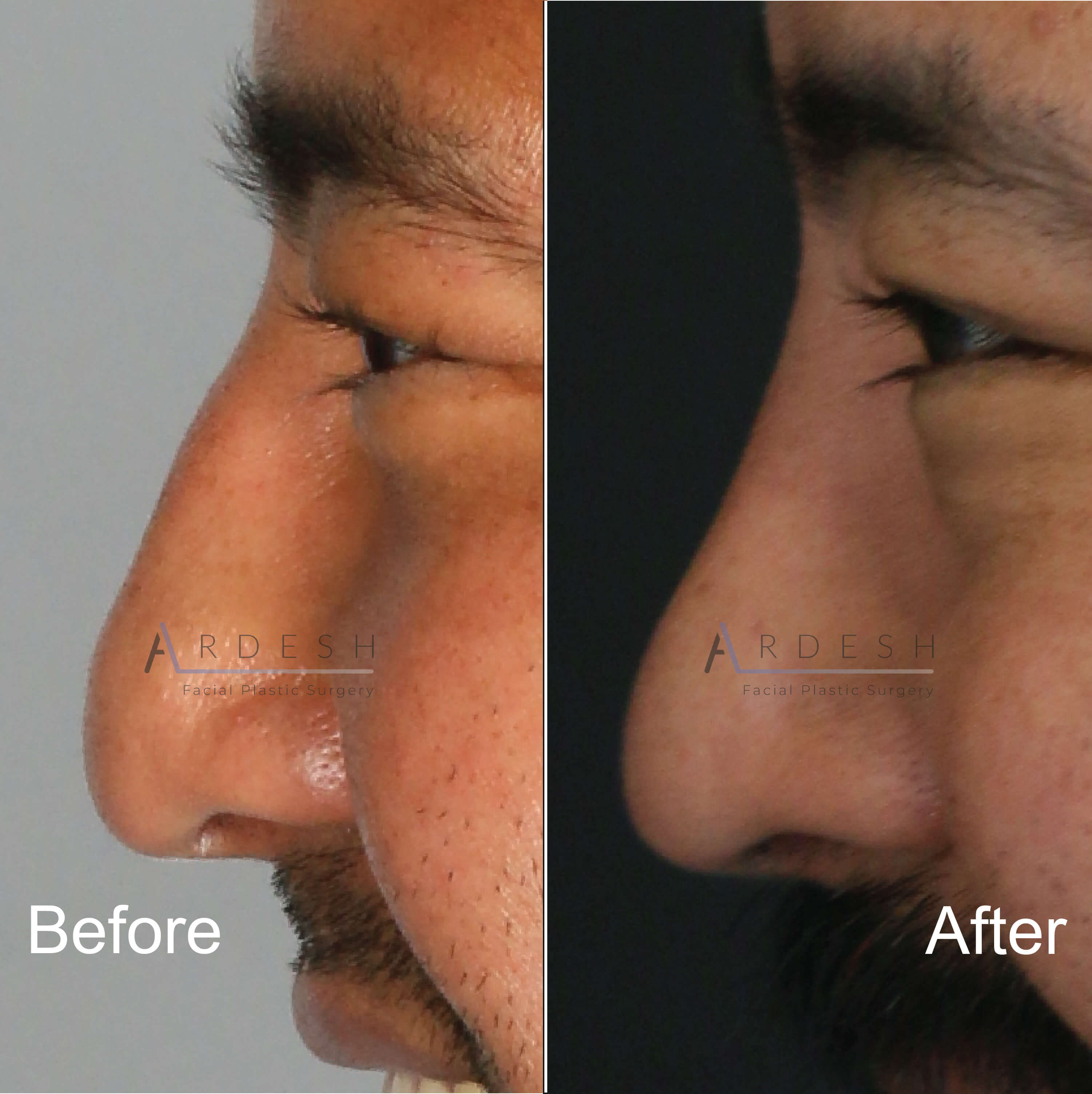 Rhinoplasty Before and After | Ardesh Facial Plastic Surgery