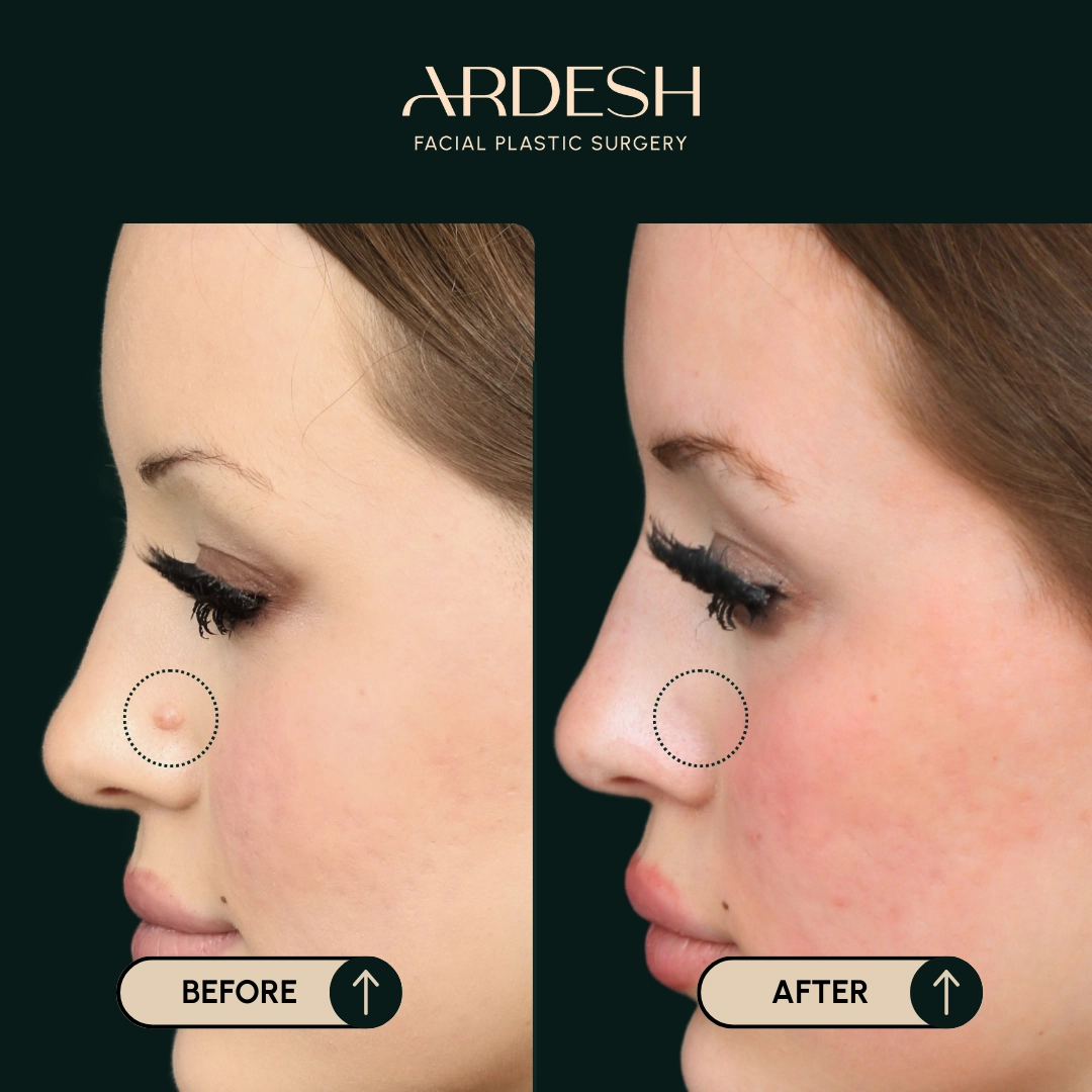 /gallery/mole-removal-1.webp