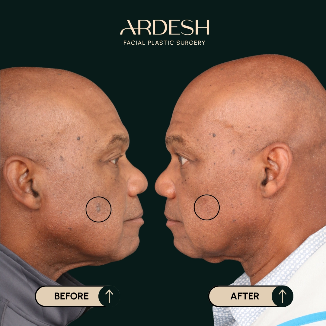 /gallery/mole-removal-2.webp
