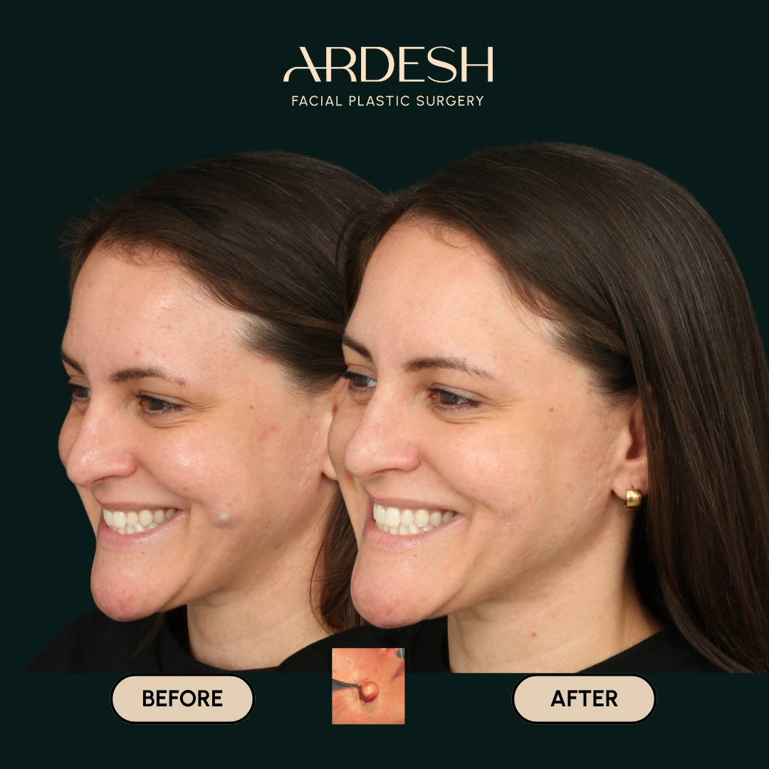 /gallery/mole-removal-4.webp