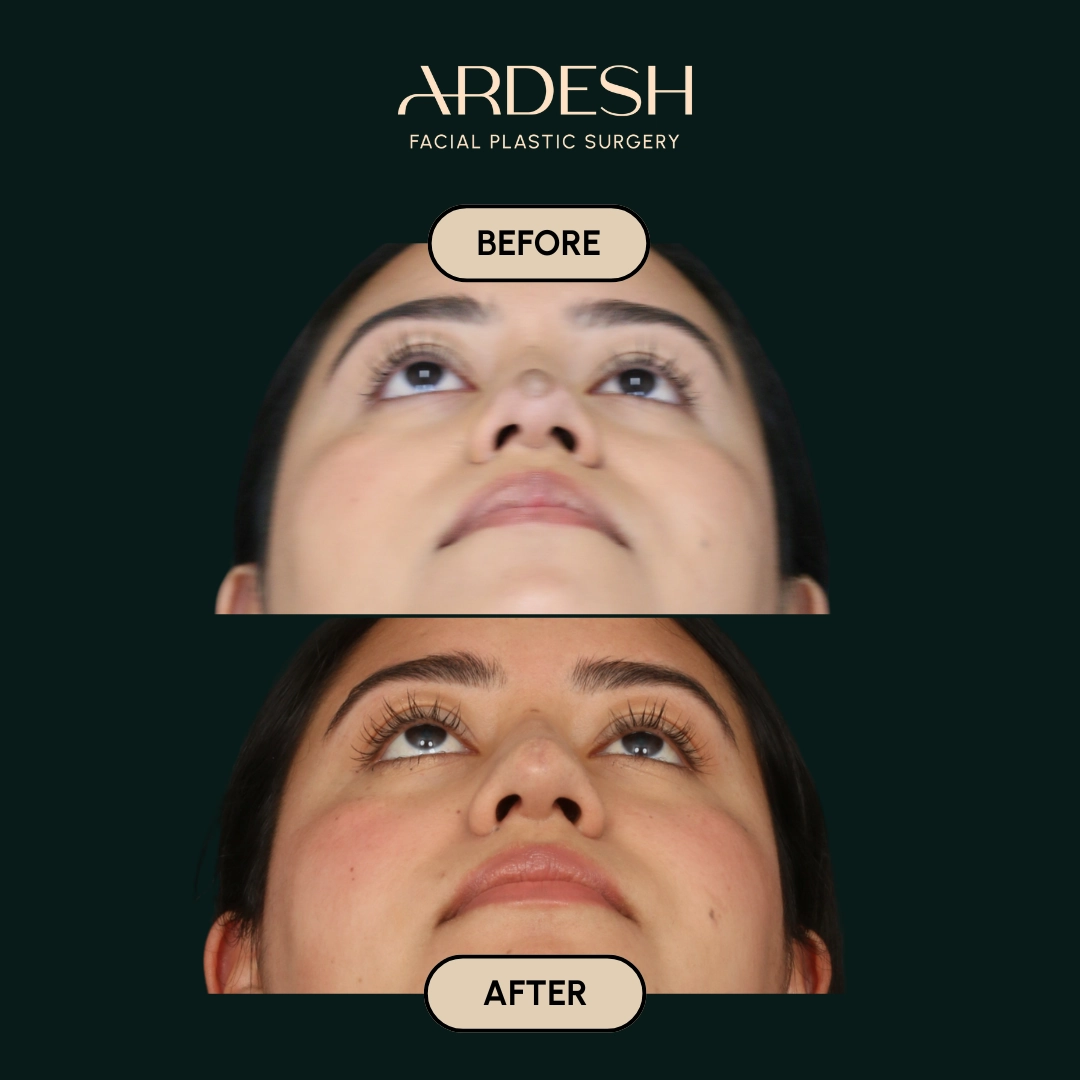 /gallery/mole-removal-6.webp